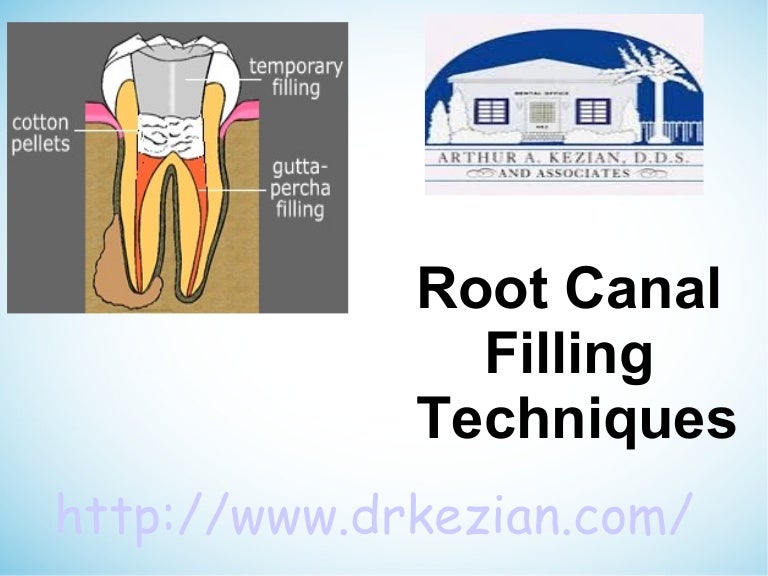 Root canal filling techniques