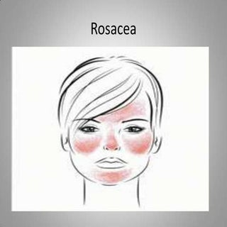 Rosacea presentation