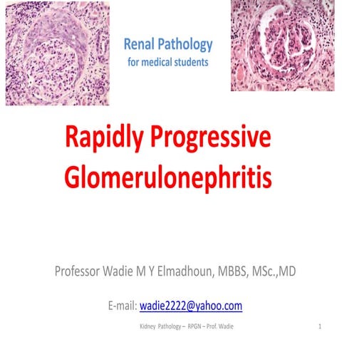 Rapidly Progressive Glomerulonephritis renal pathology prof wadie PPT