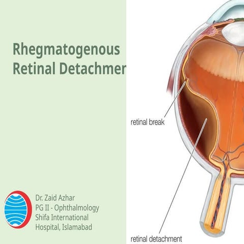 Rhegmetogenous Retinal Detachment- treatment and diagnosis.pptx
