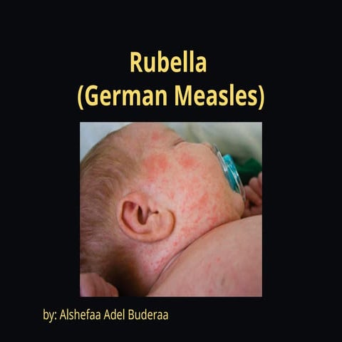 CONGENITAL RUBELLA SYNDROME | PPTX
