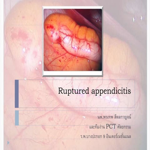Rupture appendicitis