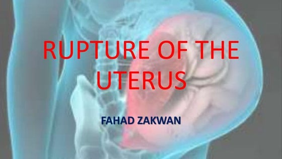Uterine rupture | PPTX | Pregnancy | Reproductive Health