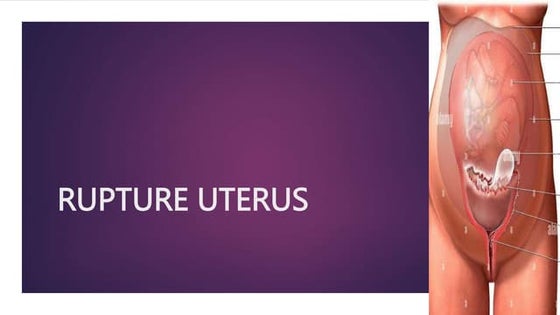 Uterine rupture | PPTX | Pregnancy | Reproductive Health