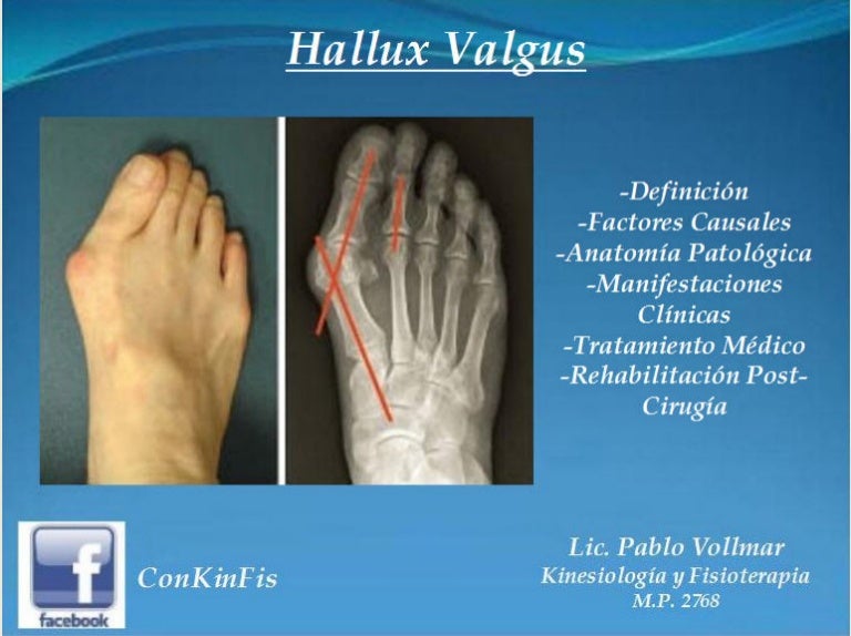 Hallux Valgus Tratamiento