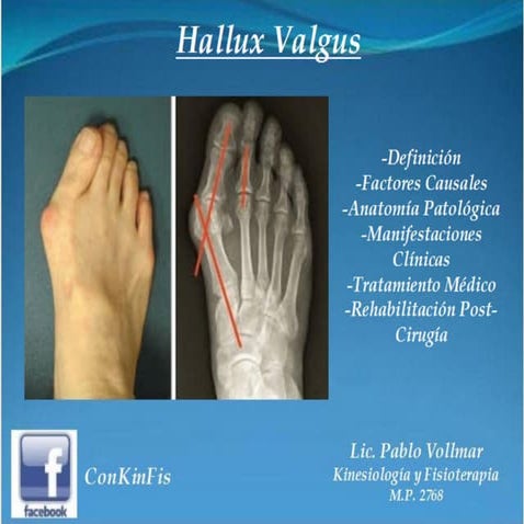 Hallux Valgus Tratamiento | PDF