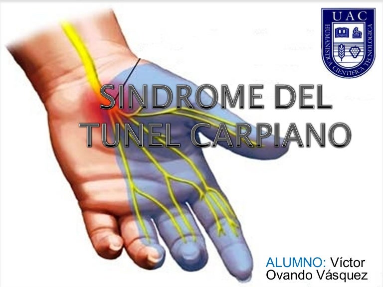 Sindrome del tunel del carpo