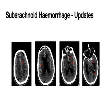 Subarachnoid hemorrhage, guidelines with new Updates.pdf