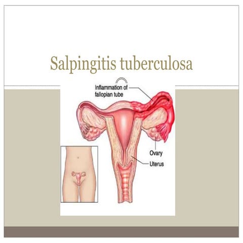 Salpingitis tuberculosa | PPTX