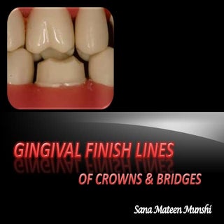 Different gingival finish lines (ma...
