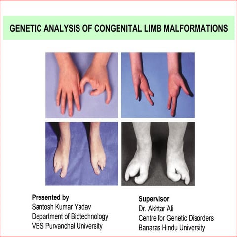 GENETIC ANALYSIS OF CONGENITAL LIMB MALFORMATIONS by Santosh yadav ppt(988958...