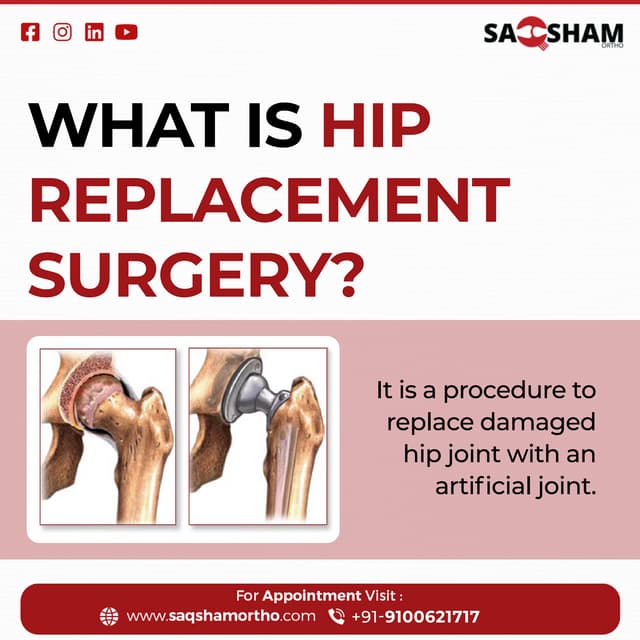 The Ultimate Guide to Hip Replacement Surgery PDF