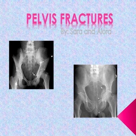 Pelvis Fractures