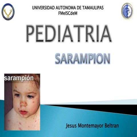 Sarampion