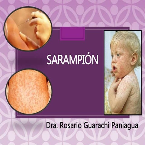 Presentacion de la enfermedad del Sarampion