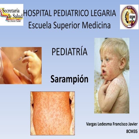 Sarampion en niños