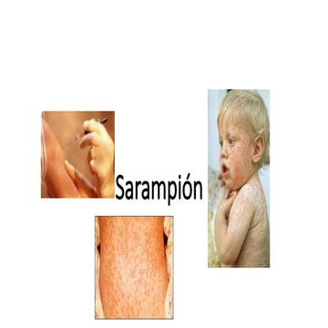 Enfermedades exantemáticas: SARAMPION.pptx