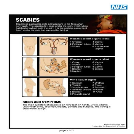 Scabies | PDF