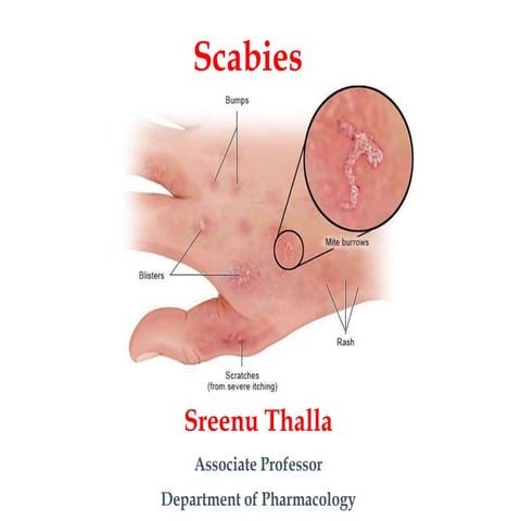 Clinical Pharmacotherapy of Scabies Disease | PPTX