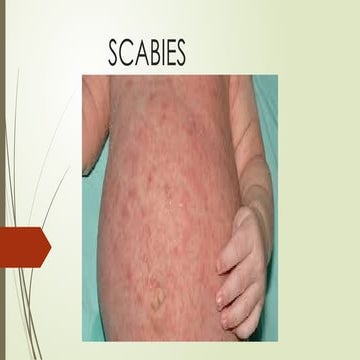 SCABIES as skin disease in adults and children