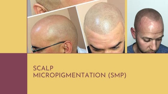 Scalp micro pigmentation (smp) SmpByHamudi | PPT