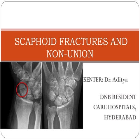 Scaphoid fracture and nonunion 