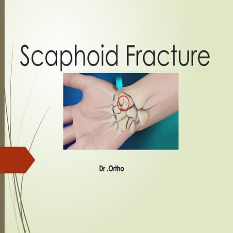 Scaphoid_Fracture_Presentation slides.pptx