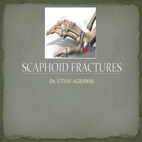 Scaphoid Fractures_UTSAV