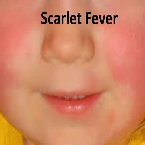 Scarlet fever.pdf234567890poiuytrew234567890p