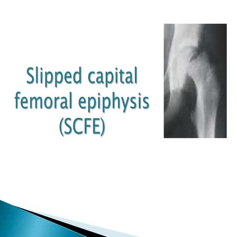 Slipped capital femoral epiphysis vamshi kiran feb 6/2013
