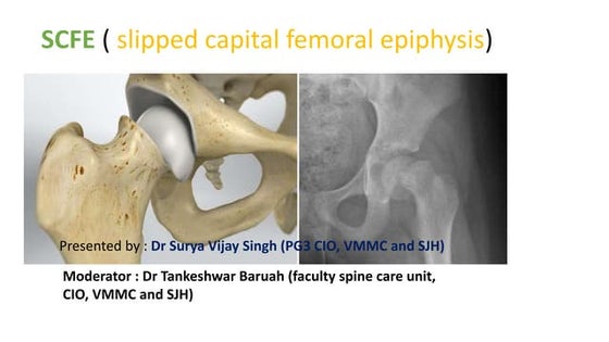 Slipped capital femoral epiphysis | PPT