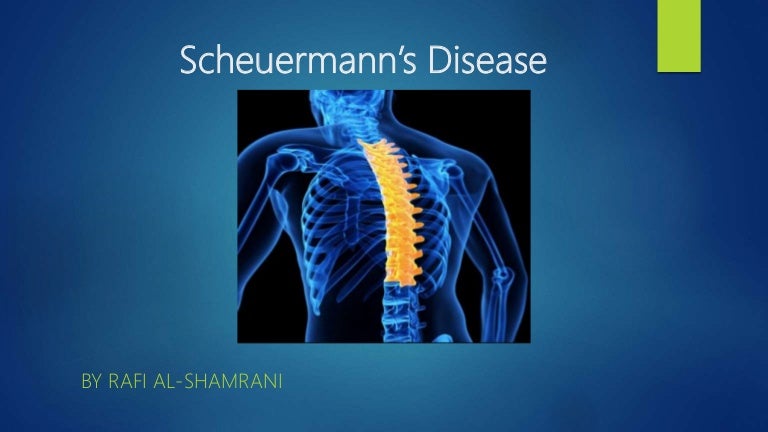 Scheuermann's disease
