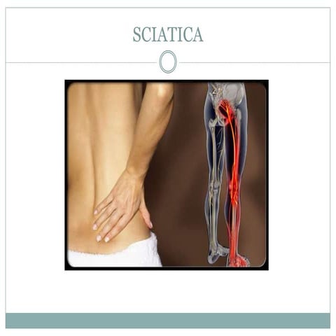 Sciatica
