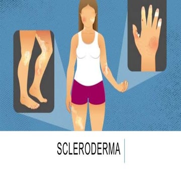 Scleroderma