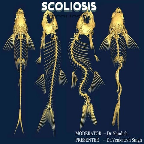 Scoliosis 