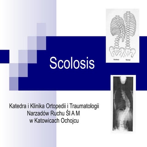 Scolosis