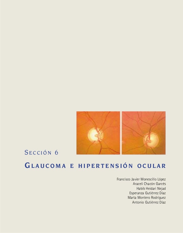 Síntomas de hipertensión ocular dolor de cabeza Síntomas de hipertensión ocular dolor de cabeza