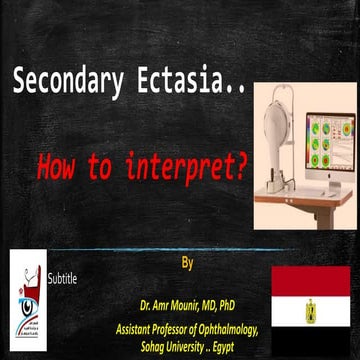 Secondary Corneal Ectasia