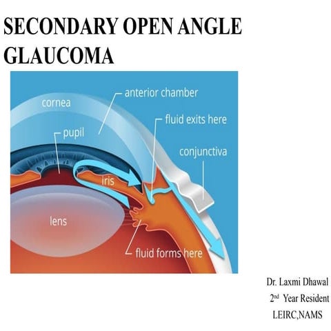 secondary open angle  glaucoma.pptx.....