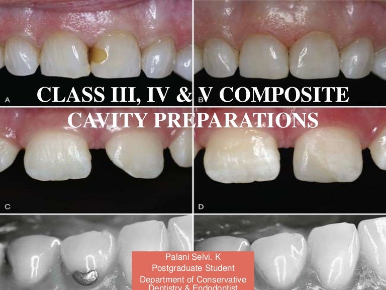 Class III, IV, V Cavity preparations for Composites SELVI