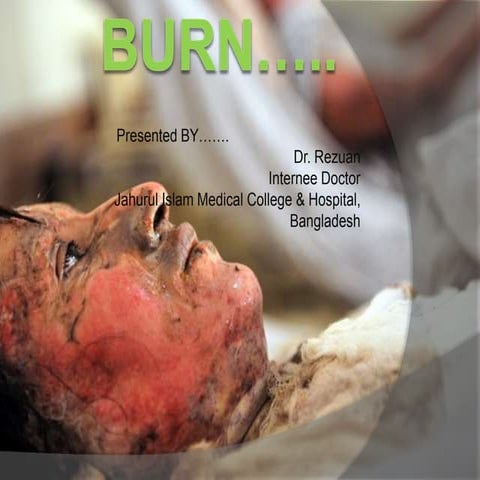 BURN ... by Dr. Rezuan ..  JIMCH , Bangladesh