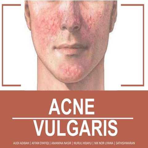 Acne Vulgaris