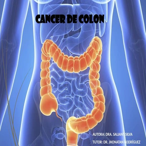 seminario de patologías malignas de colon | PPTX
