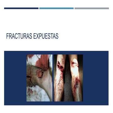 Fracturas expuestas