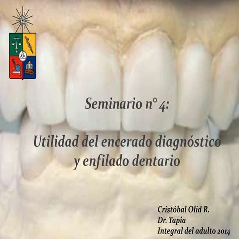 Seminario 4: Utilidad del encerado diagnóstico y enfilado dentario | PPTX