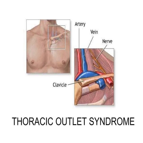 Seminar tos THORACIC OUTLET SYNDROME | PPT