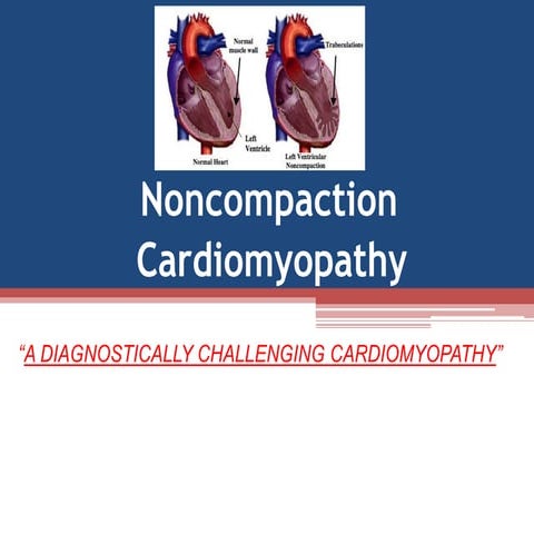 Noncompaction cardiomyopathy