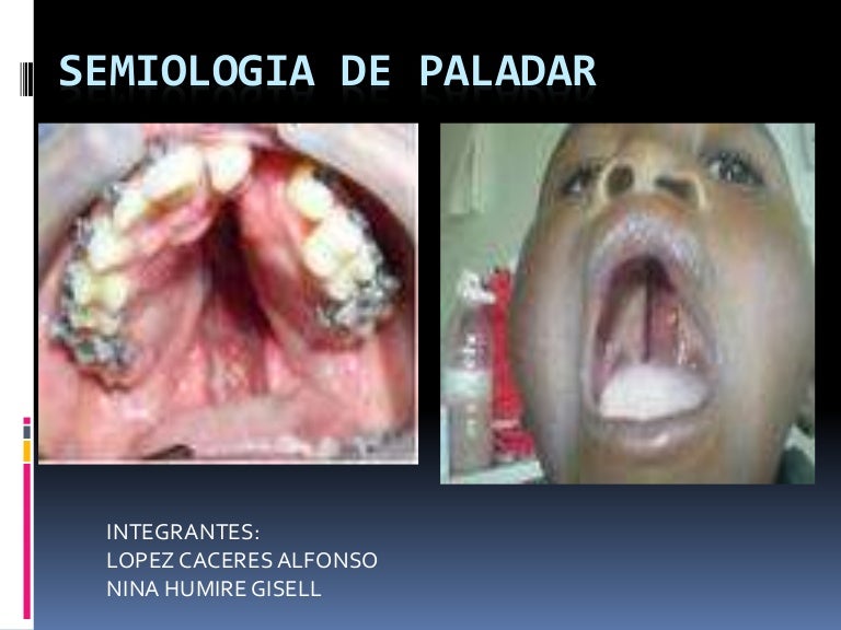 Semiologia del paladar Semiologia del paladar