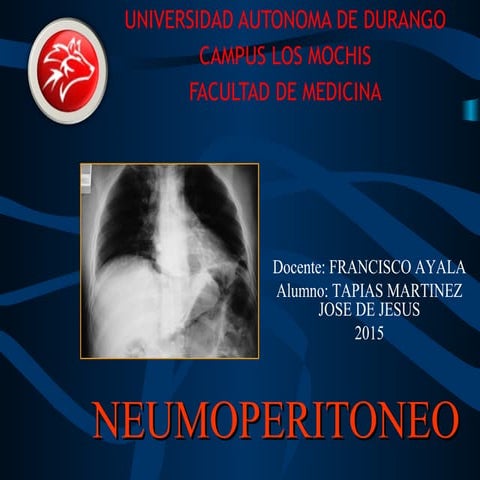 Semiologia radiologica del neumoperitoneo