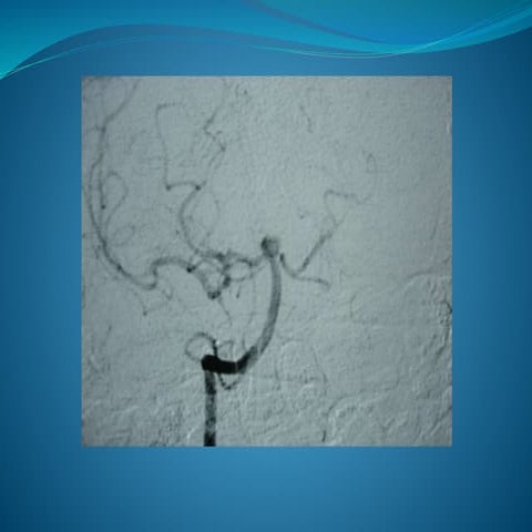 Serebrovasküler Vak'alar (anevrizma + avm)